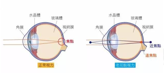 白內障和老花眼區別，老花眼發(fā)病率正呈現年輕化趨勢